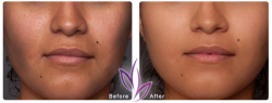 before after FacialTreatment