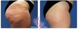 before after BodyTreatment