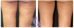 before after BodyTreatment