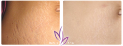 before after BodyTreatment