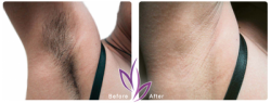 before after LaserHairRemoval