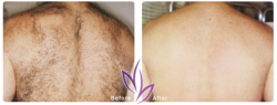 before after LaserHairRemoval