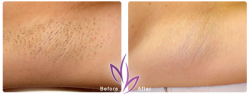before after LaserHairRemoval