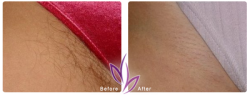 before after LaserHairRemoval