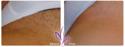 before after LaserHairRemoval