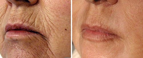 Fotona XP acne scars