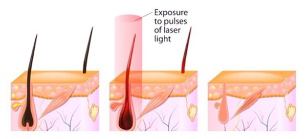 Laser Procedure